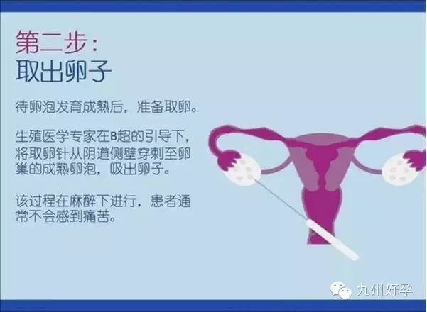 试管婴儿的五个具体步骤是什么？