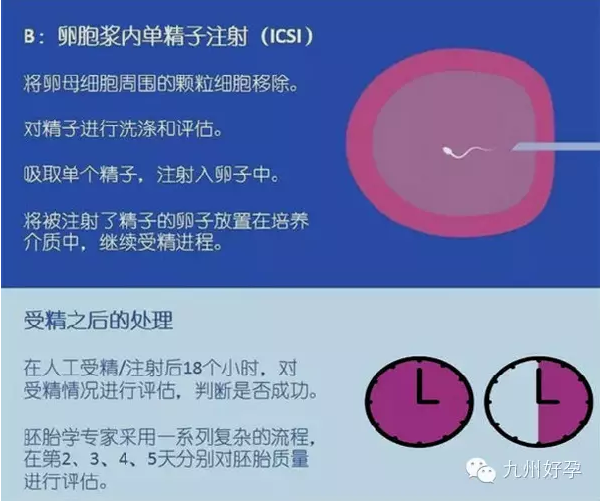 试管婴儿的五个具体步骤是什么？