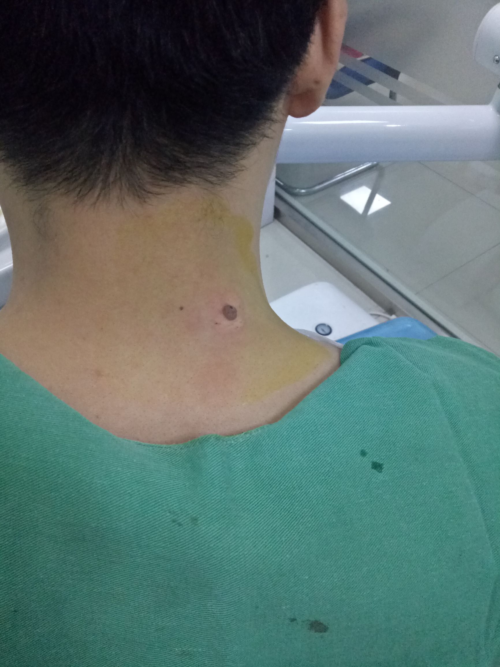 痣长在肩膀和脖子的交界处_达一风水网