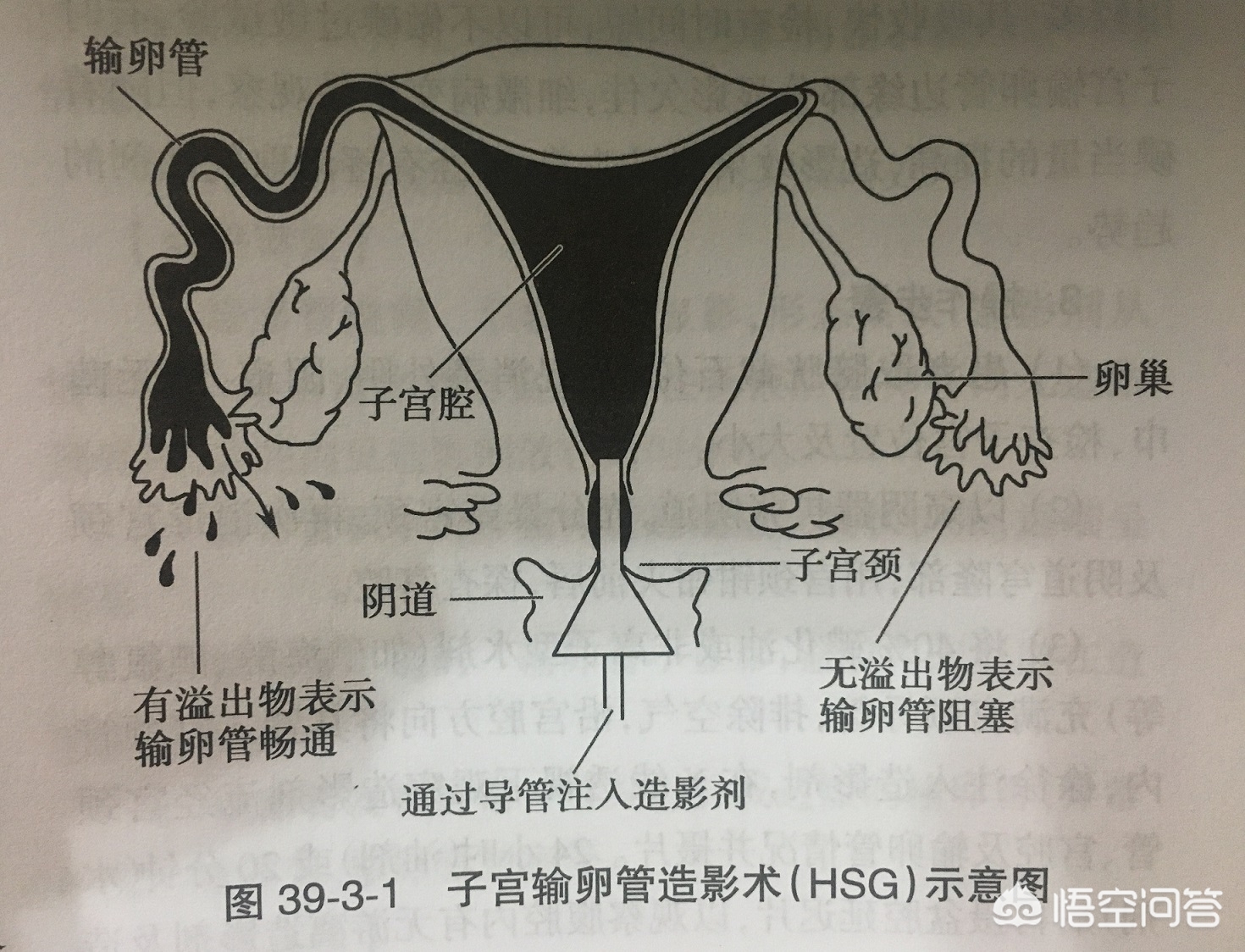 子宫输卵管造影怎么做，多少钱一次