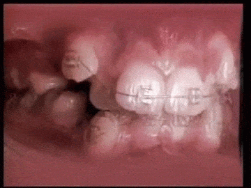 牙套一般带几年(戴牙套为什么要那么长时间？)