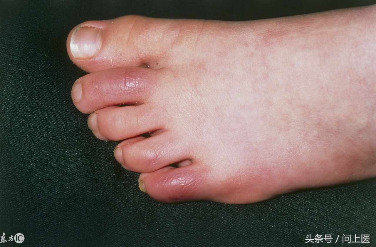 冰疮最初的症状图片(为什么有的人在寒冷天气会长冻疮) - 赤虎壹号
