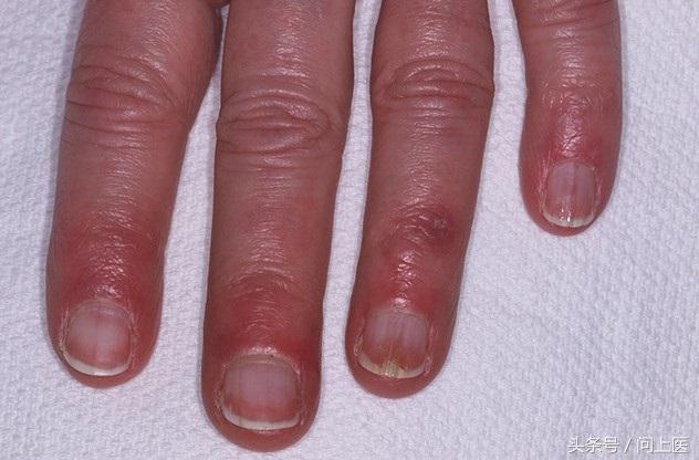 冰疮最初的症状图片(为什么有的人在寒冷天气会长冻疮) - 赤虎壹号