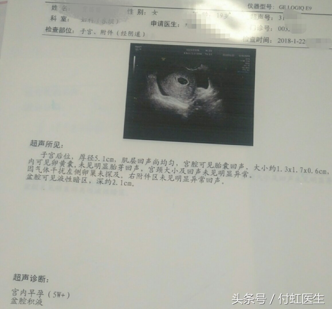 早孕5+周，盆腔有积液，是要流产了吗？