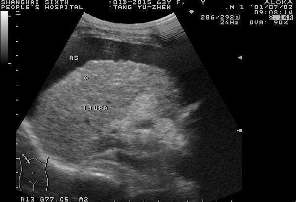 孕妇为什么测甲胎蛋白？