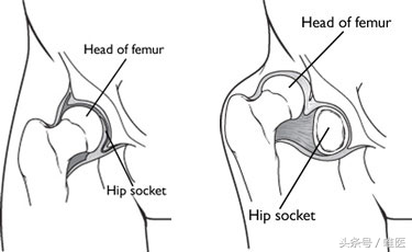 专业科普：髋关节发育不良，婴幼儿宝妈知识必备！