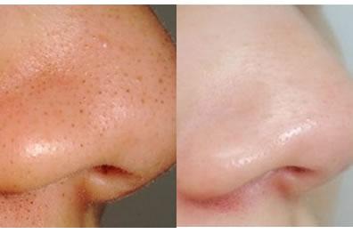 你不可不知道的小诀窍，帮你祛黑头少有弯路