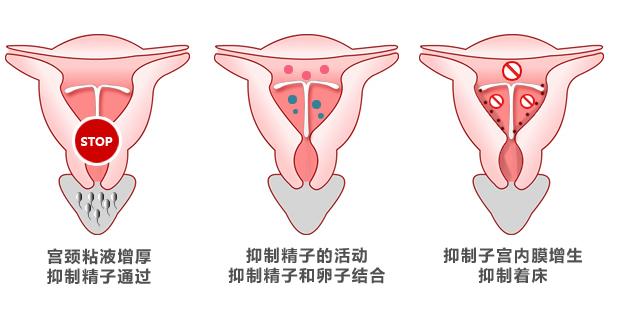 取环那些事，上节育环到底好不好？