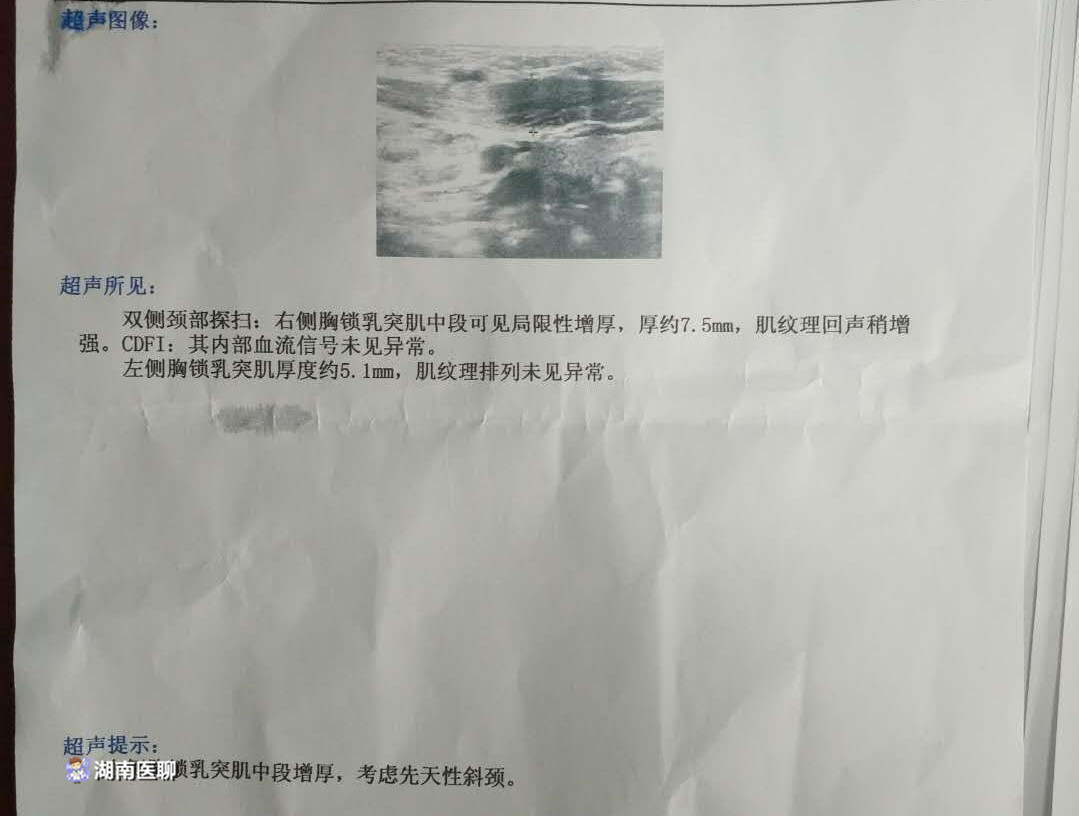 宝宝先天斜颈，出生半年内治疗最佳！赶紧检查下宝宝脖子