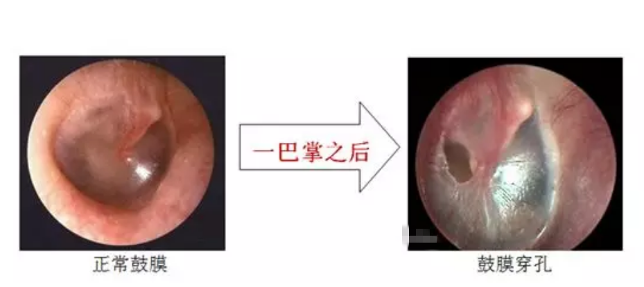 仅打一耳光，听力下降甚至会聋？耳朵鼓膜破了怎么办？