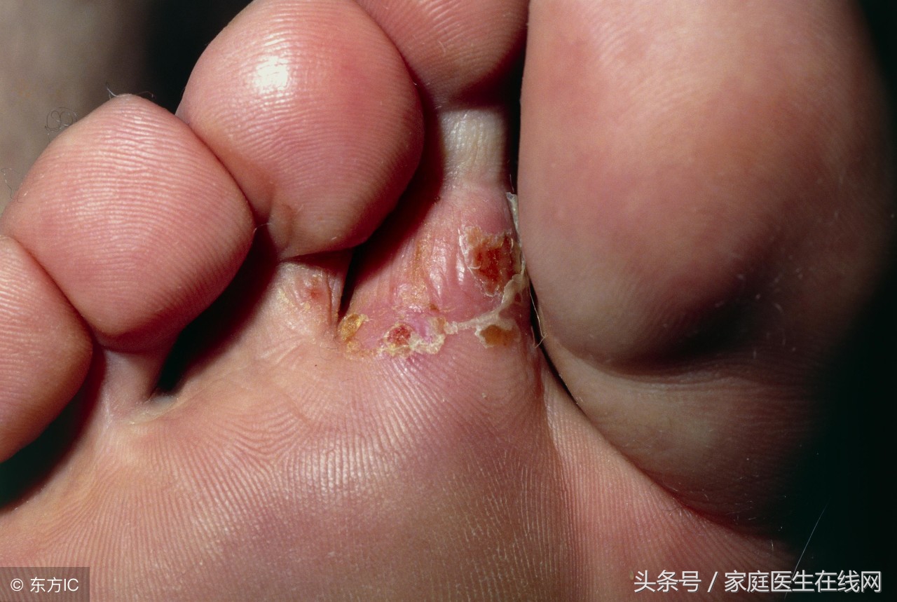 脚气如何根治？与脚气病有何区别？