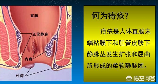 得了痔疮怎么办，是不是所有的痔疮都需要手术，听听医生怎么说