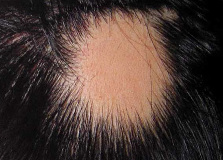 男人掉头发的原因有哪些？如何通过饮食改善脱发
