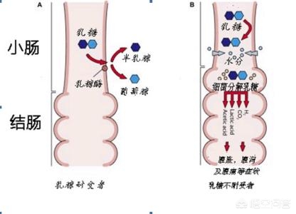 婴儿乳糖不耐受到底要不要添加乳糖酶？