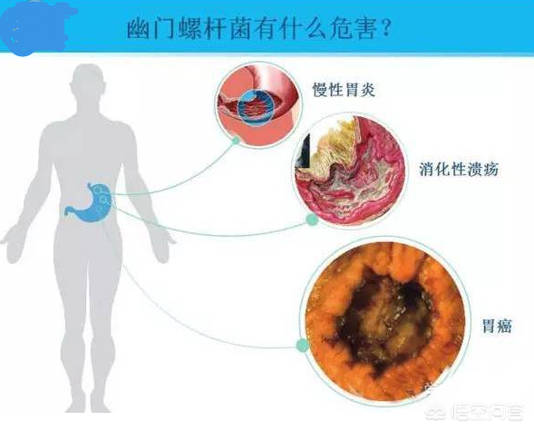 幽门螺杆菌是什么？  怎么确认自己是否感染幽门螺杆菌?