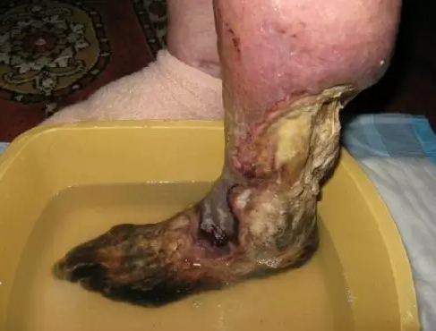 化学名为二氢去氧吗啡,是一种可待因和碳氢化合物组成的混合物.