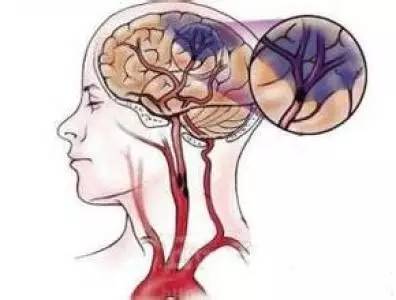 大脑缺氧超3秒如何急救？快速恢复脑部供氧的方法