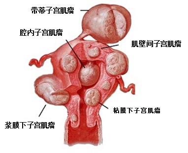 子宫肌瘤是最常见的妇科肿瘤之一严重的甚至发生恶变，危及生命!