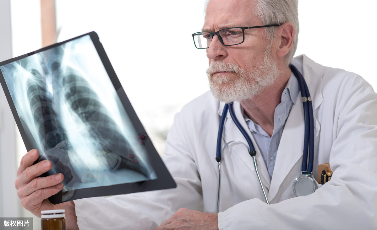 肺部X光扫描有阴影就是肺癌？医生：不一定，有可能是这4种病