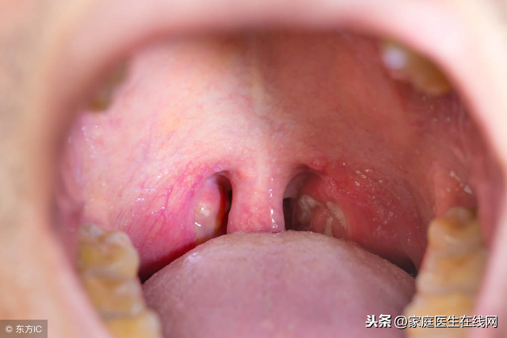 喉咙里夹出的“臭石头”是什么东西？这3个因素是致病来源
