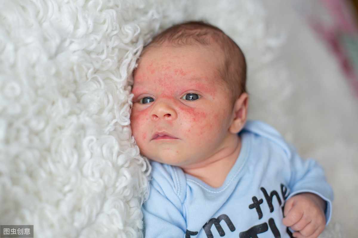 婴儿湿疹的诊断治疗研究进展 - 爱爱医医学网
