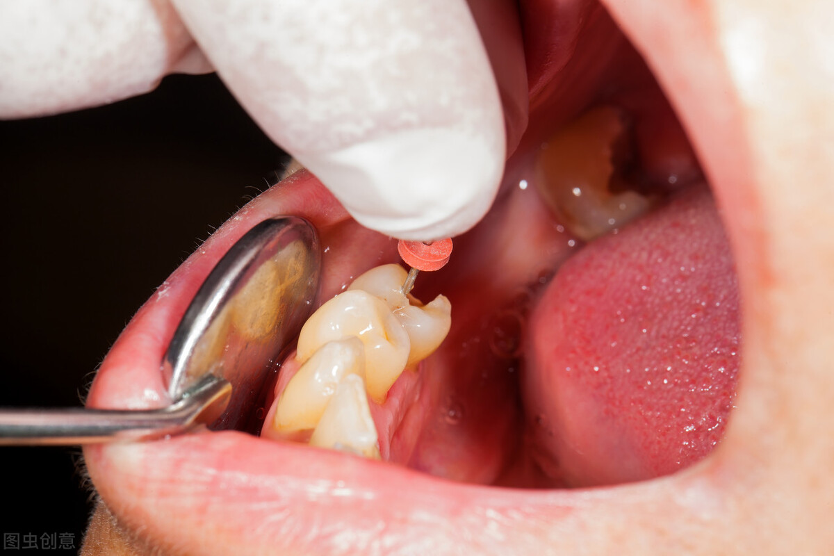牙齿龋坏严重！要做根管治疗和打桩，可以同时进行吗？