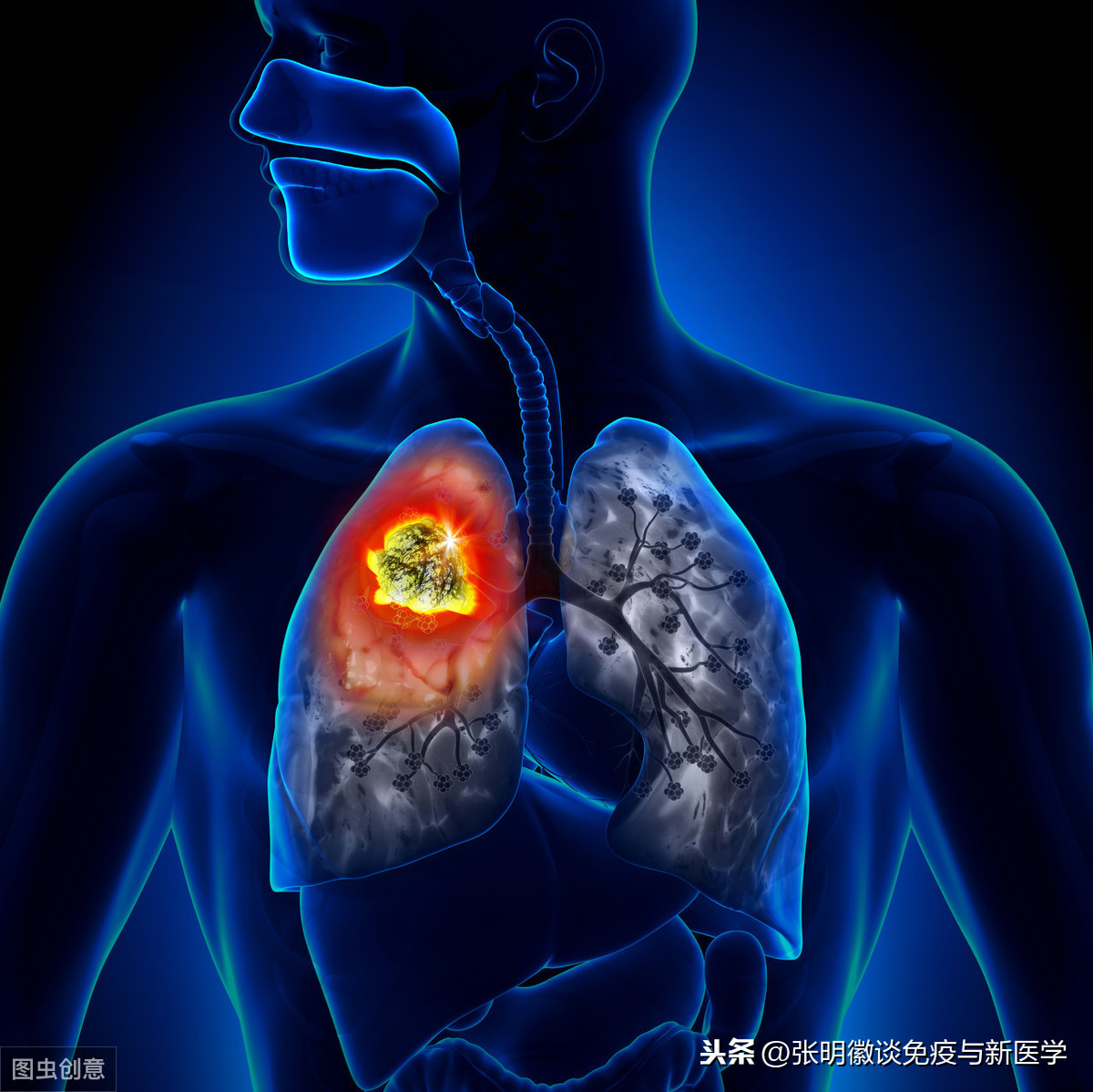 为什么会形成肺结节？如果出现这种情况，就要警惕是否是肺癌