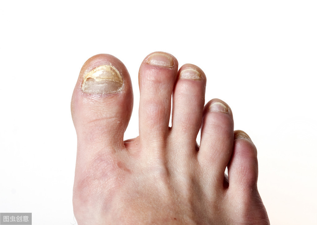 灰指甲有哪些症状呢?