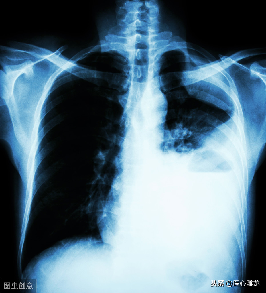 肺积水治疗一般多少钱(胸腔积液怎么治)