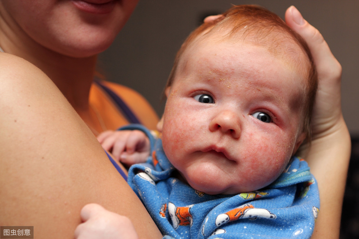 婴儿湿疹不用干着急！3大治疗原则、6个护理建议送给宝妈