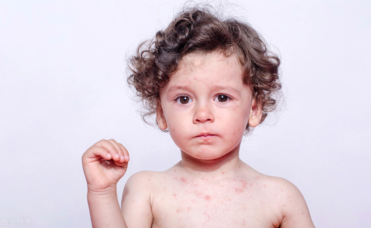 成年人为什么会长“水痘”？带状疱疹到底是怎么回事？怎么治疗？