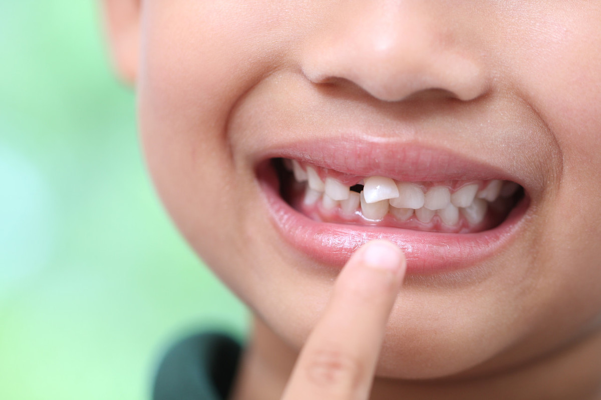 儿童门牙长歪图片(当孩子出现这20种牙颌畸形问题) 