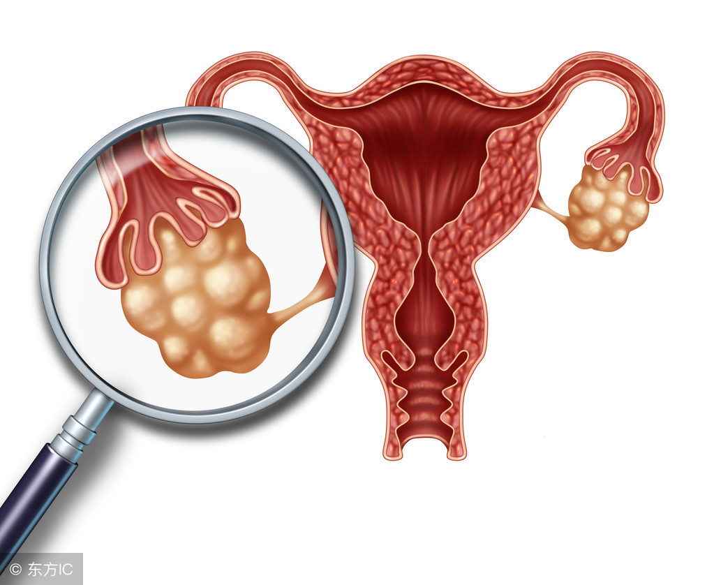 什么是多囊卵巢综合征？患病女性能怀孕？文章给你一个明确答案！