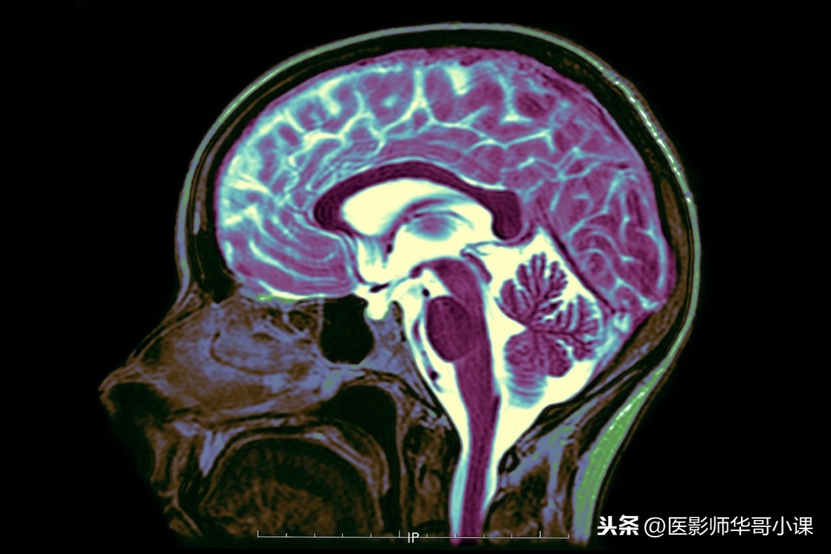 经常头痛头晕不舒服了，是做头颅CT还是磁共振MRI好呢？各显神通