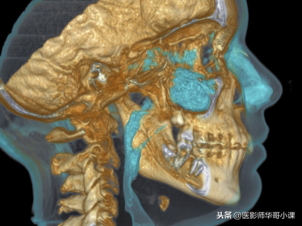 经常头痛头晕不舒服了，是做头颅CT还是磁共振MRI好呢？各显神通