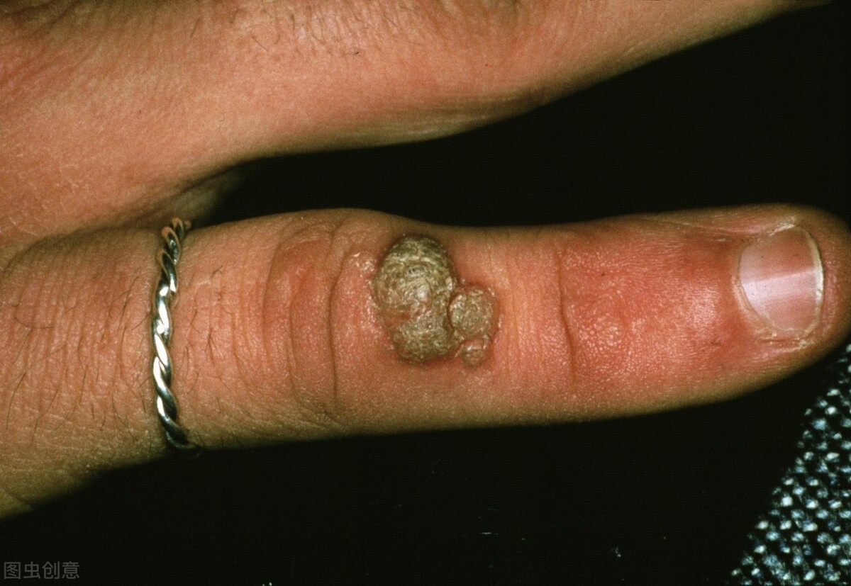 人乳头瘤病毒图片初期图片