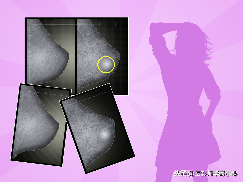看看你的乳腺片，拍摄要花多少钱，哪些人适应做乳腺钼靶检查