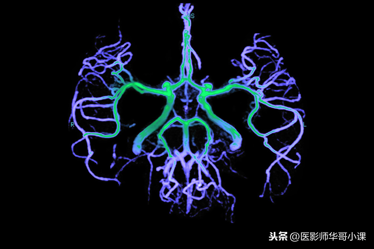 经常头痛头晕不舒服了，是做头颅CT还是磁共振MRI好呢？各显神通