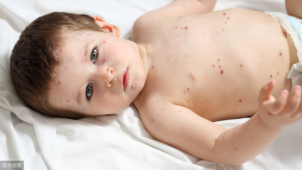小孩子出水痘父母要如何护理，如何避免出水痘留疤