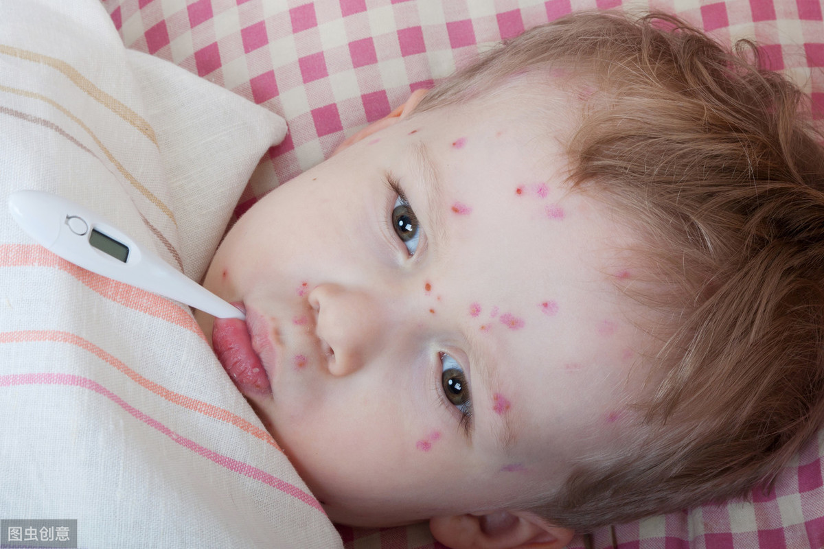 小孩子出水痘父母要如何护理，如何避免出水痘留疤