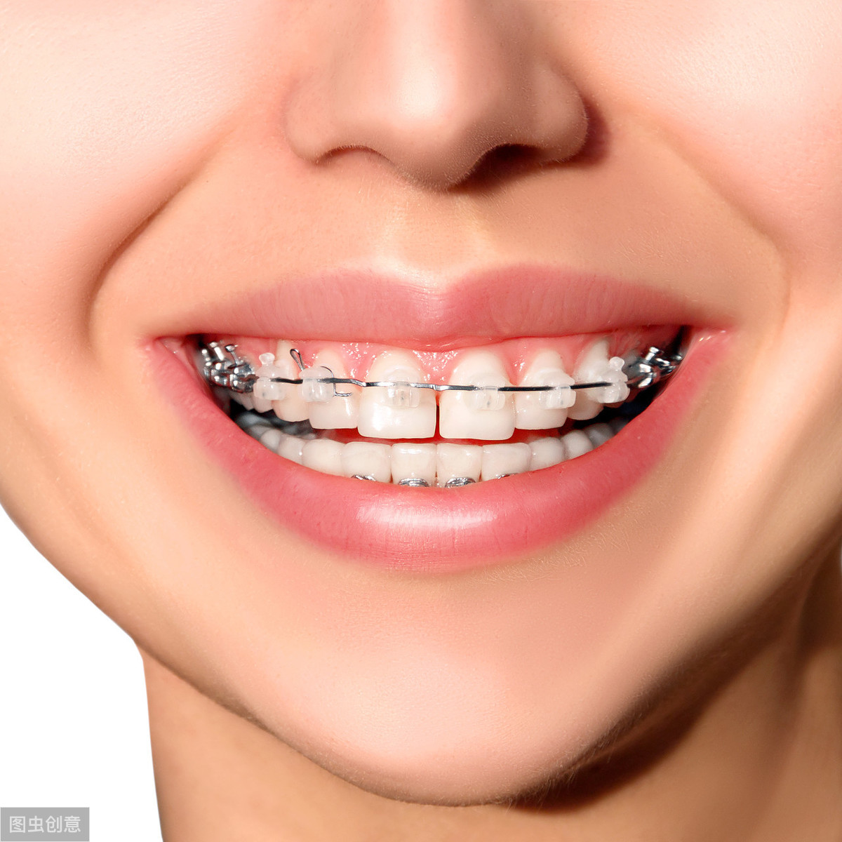 牙齿矫正报价里有多少水分?资深牙医为你揭秘(二)