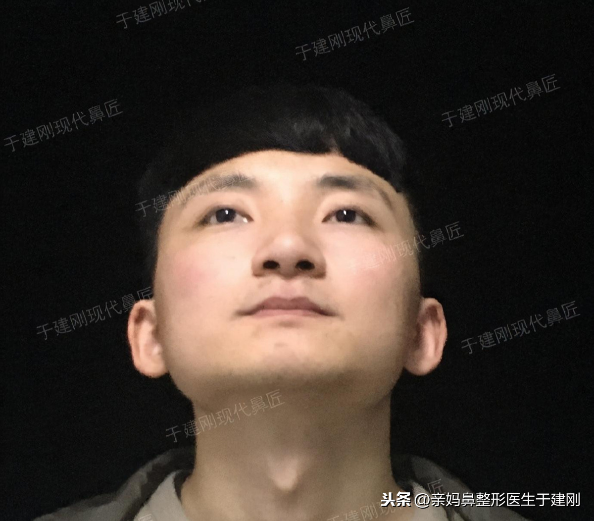 男生隆鼻术后效果怎么样？来看看“鹰钩鼻”小伙耳软骨隆鼻后效果