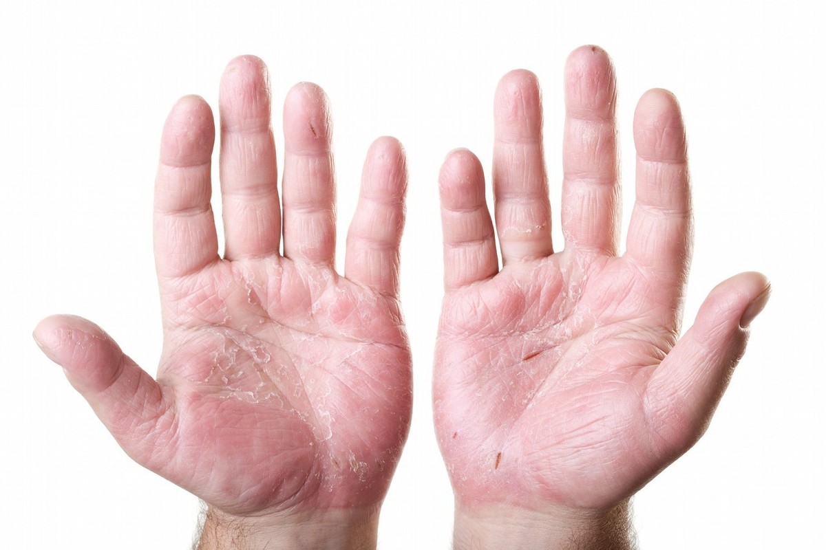 是银屑病，还是玫瑰糠疹？搞清楚这5点不同，及时治疗