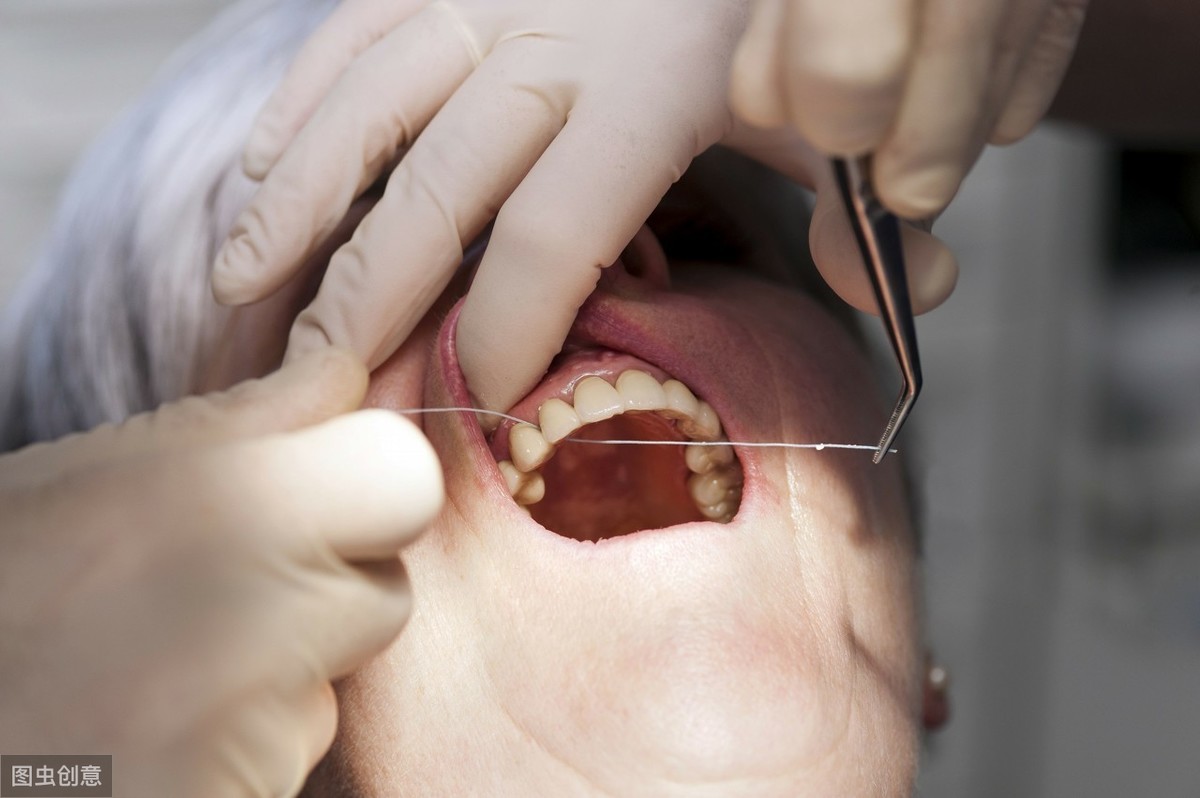 牙齿烂了之后，补牙后医生建议要戴牙冠，真的有必要吗？