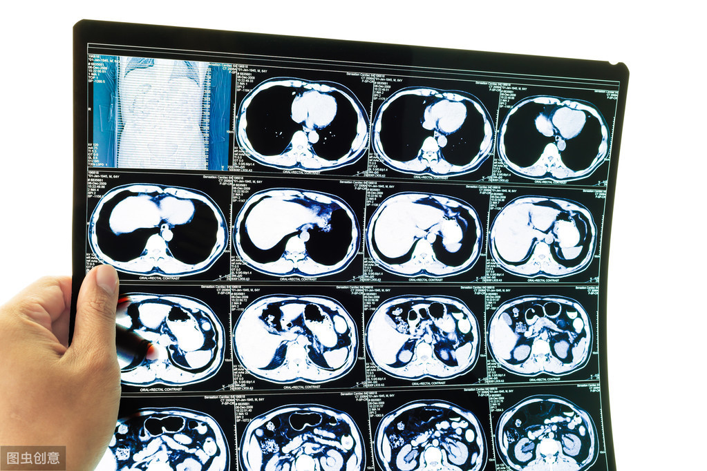 都是CT却各有不同，带您快速了解平扫CT增强CT薄层CT分别是什么？