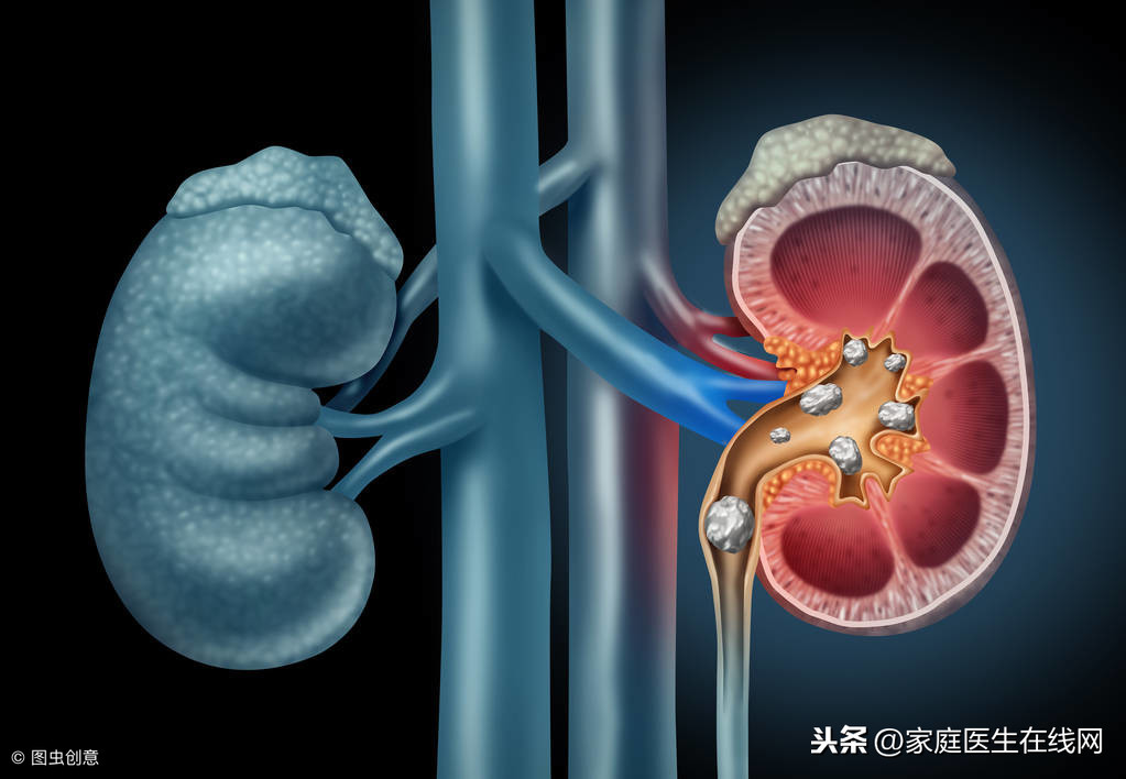 肾结石注意事项及饮食禁忌（肾结石患者牢记这6个禁忌）