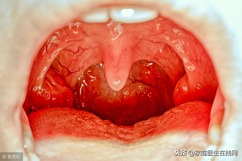 喉咙里夹出的“臭石头”是什么东西？这3个因素是致病来源