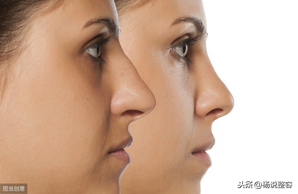 隆鼻整形：细讲隆鼻的利弊、风险与​隆鼻的效果持续性等问题