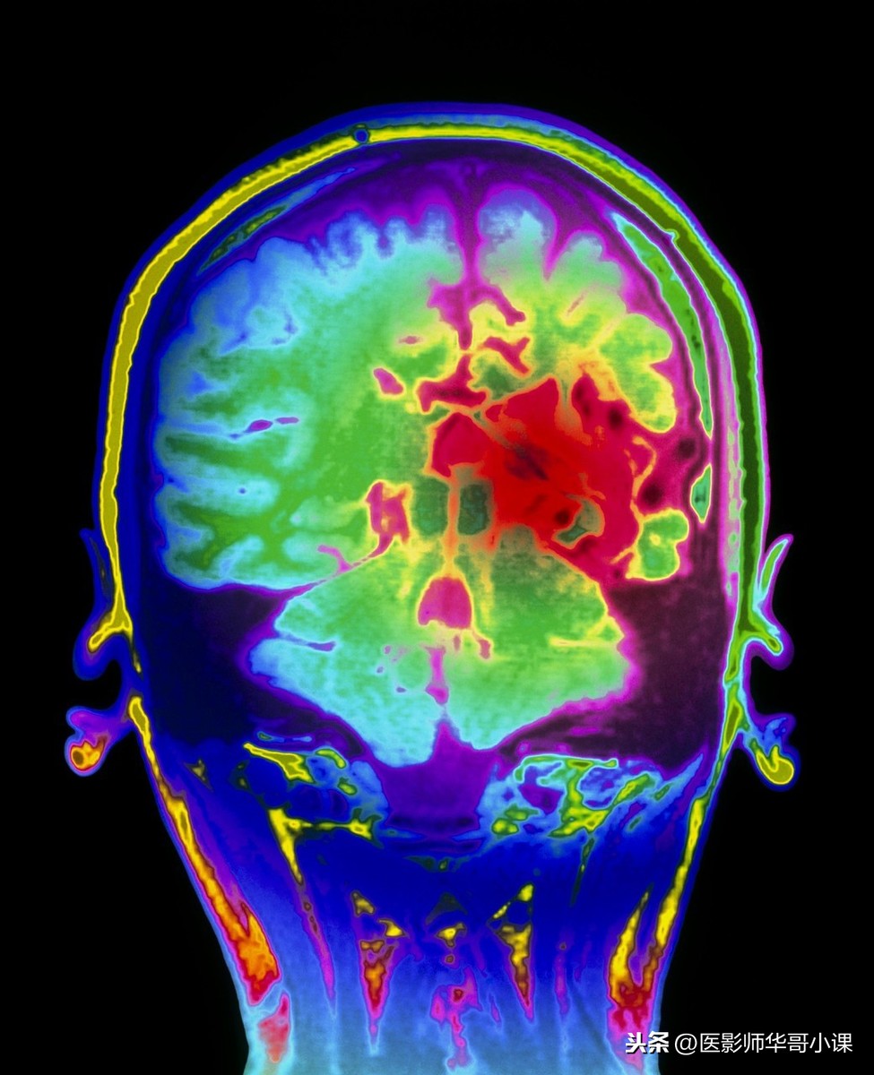 经常头痛头晕不舒服了，是做头颅CT还是磁共振MRI好呢？各显神通