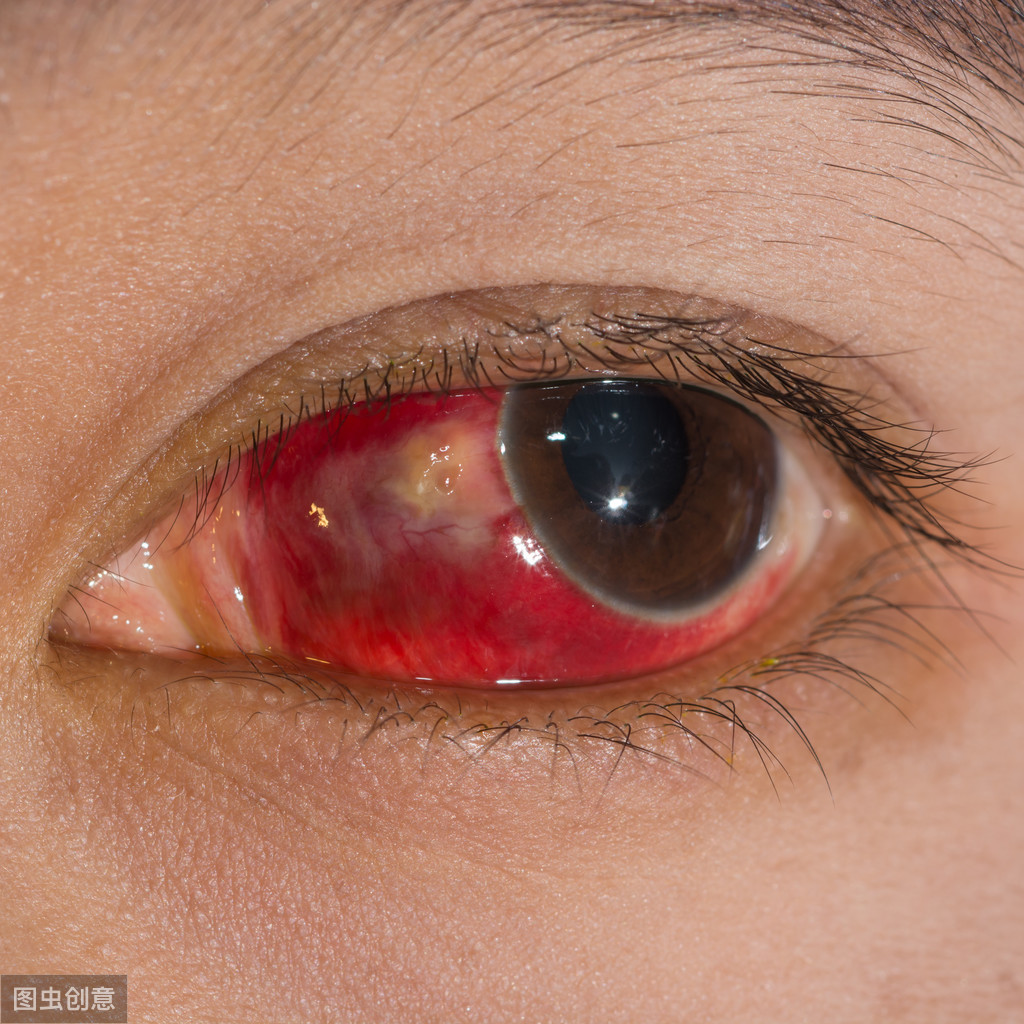 如果是颅脑外伤后,眼睛并没有受伤,而眼睛上穹窿部可见结膜下出血的